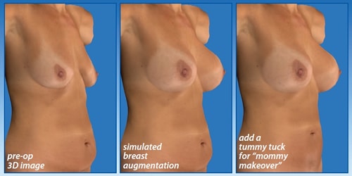 Vectra® 3D Breast Imaging Orange CT