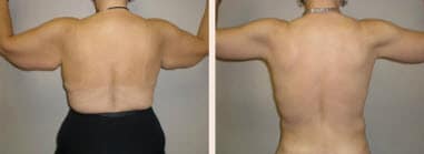 Arm Lift
