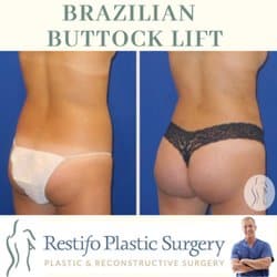Before & After Images of Brazilian Buttock Lift Orange CT
