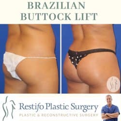 Before & After Images of Brazilian Butt Lift Orange CT