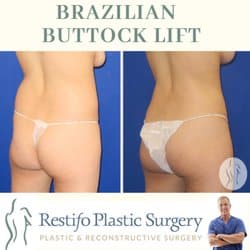 Before & After Brazilian Butt Lift Orange CT