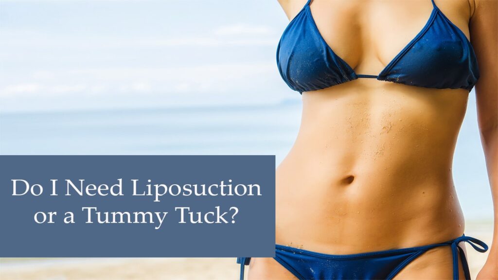 Do I need Liposuction or a Tummy Tuck
