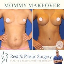 Mommy Makeover 1