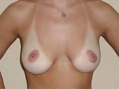 After Image: Breast Reduction - front