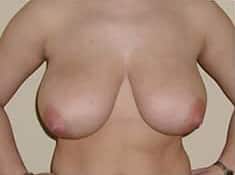 Before Image: Breast Reduction - front