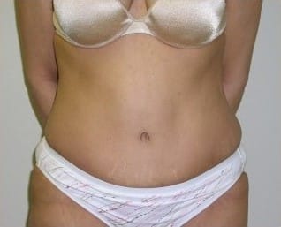 After Image: Abdominoplasty - front
