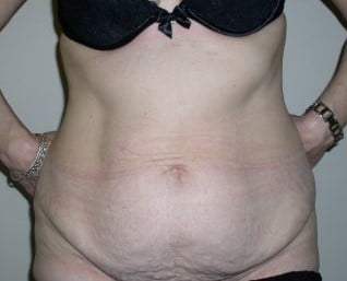 Before Image: Abdominoplasty - front