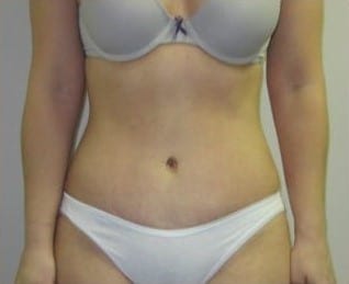 After Image: Abdominoplasty - front