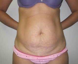 Before Image: Abdominoplasty - front
