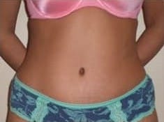 After Image: Abdominoplasty - front