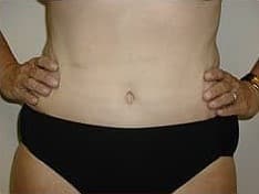 After Image: Abdominoplasty - front