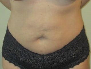 Before Image: Abdominoplasty - front