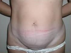 Before Image: Abdominoplasty - front