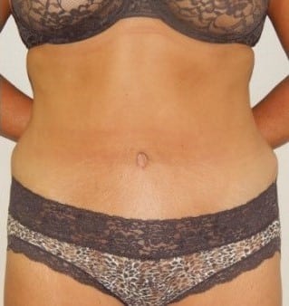 After Image: Abdominoplasty - front