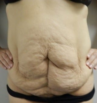 Before Image: Abdominoplasty - front