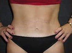 After Image: Abdominoplasty - front