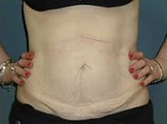 Before Image: Abdominoplasty - front