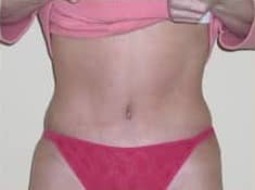 After Image: Abdominoplasty - front