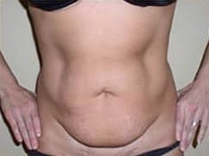 Before Image: Abdominoplasty - front