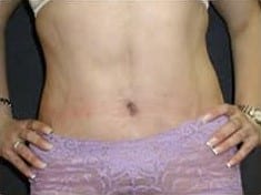 After Image: Abdominoplasty - front