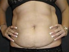 Before Image: Abdominoplasty - front
