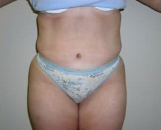 After Image: Abdominoplasty - front