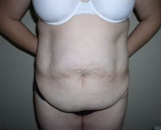 Before Image: Abdominoplasty - front