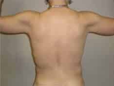 After Image: Brachioplasty - back