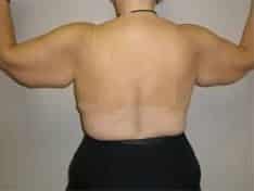 Before Image: Brachioplasty - back