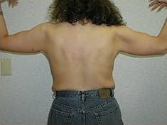 After Image: Brachioplasty - back