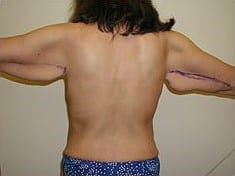 Before Image: Brachioplasty - back