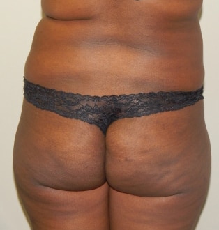 Before Image: Brazilian Buttock Lift - back