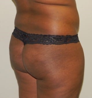 Before Image: Brazilian Buttock Lift - right-back-oblique