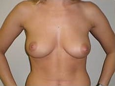 Before Image: Breast Augmentation - front