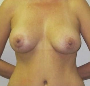 After Image: Breast Augmentation with Lift - front