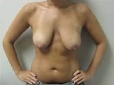 Before Image: Breast Augmentation with Lift - front