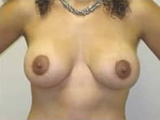 After Image: Breast Augmentation with Lift - front