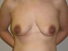 Before Image: Breast Augmentation with Lift - front