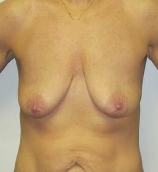Before Image: Breast Augmentation with Lift - front