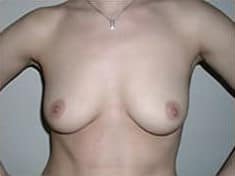 Before Image: Breast Augmentation - front