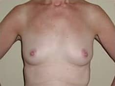 Before Image: Breast Augmentation - front