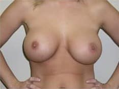 After Image: Breast Augmentation - front