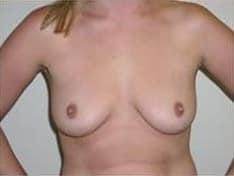 Before Image: Breast Augmentation - front