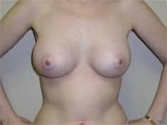 After Image: Breast Augmentation - front
