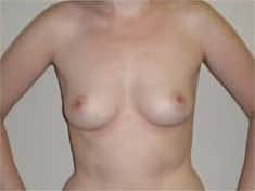 Before Image: Breast Augmentation - front
