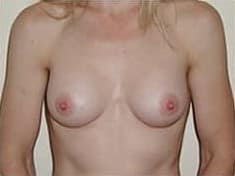 After Image: Breast Augmentation - front