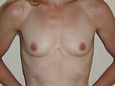 Before Image: Breast Augmentation - front