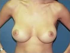 After Image: Breast Augmentation - front