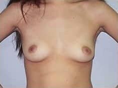 Before Image: Breast Augmentation - front