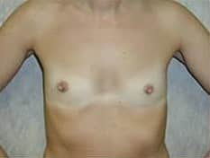 Before Image: Breast Augmentation - front